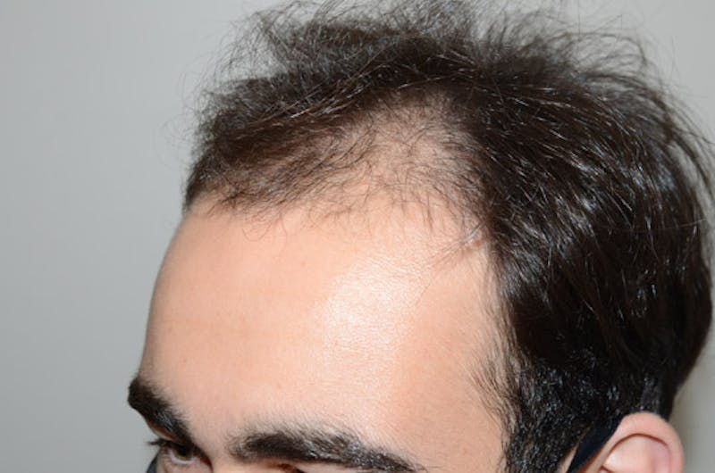 Hair Restoration for Men Before & After Gallery - Patient 267913 - Image 3