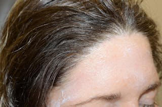 Hair Procedures for Women Before & After Gallery - Patient 319595 - Image 6
