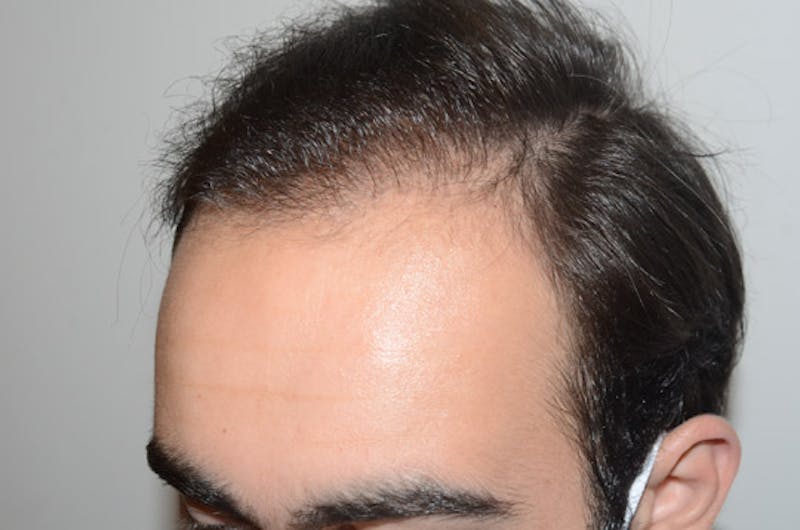 Hair Restoration for Men Before & After Gallery - Patient 267913 - Image 4