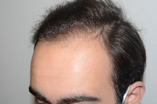 Hair Transplant Repair Before & After Gallery - Patient 384356 - Image 4