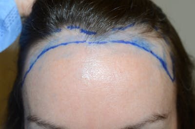 Hair Procedures for Women Before & After Gallery - Patient 339852 - Image 1