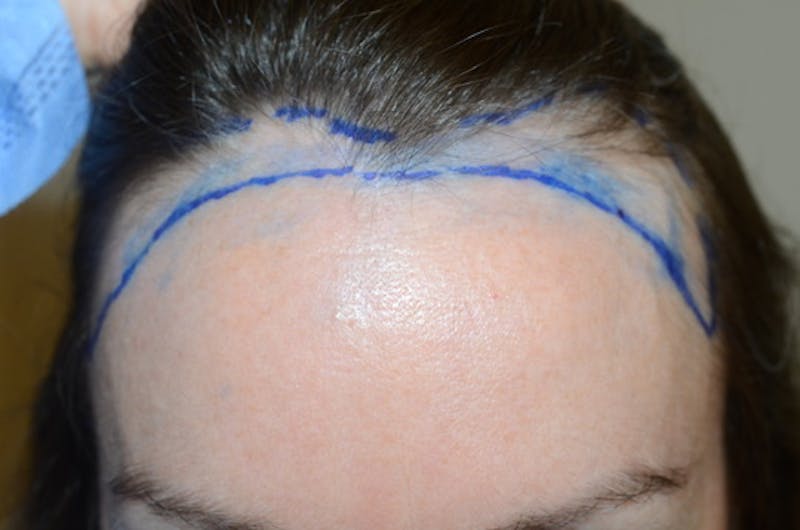 Hair Procedures for Women Before & After Gallery - Patient 298738 - Image 1