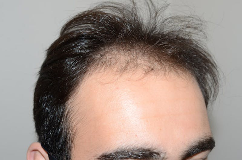 Hair Restoration for Men Before & After Gallery - Patient 267913 - Image 5