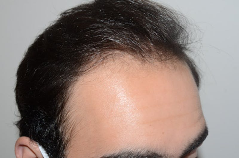 Hair Restoration for Men Before & After Gallery - Patient 267913 - Image 6