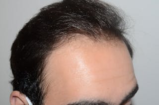 Hair Transplant Repair Before & After Gallery - Patient 384356 - Image 6