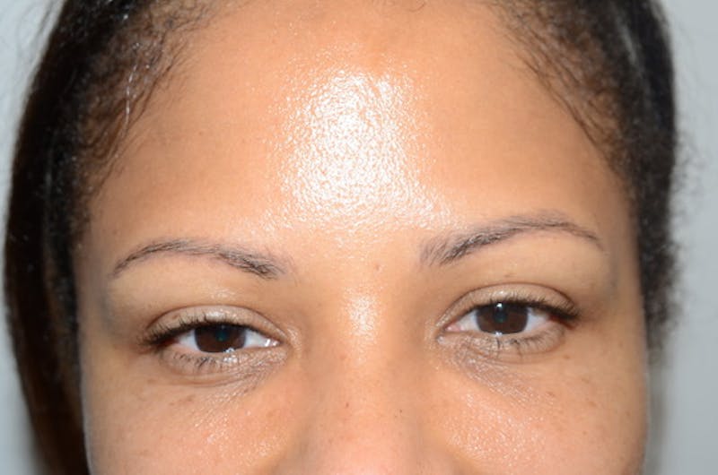 Eyebrow Transplantation Before & After Gallery - Patient 336107 - Image 1