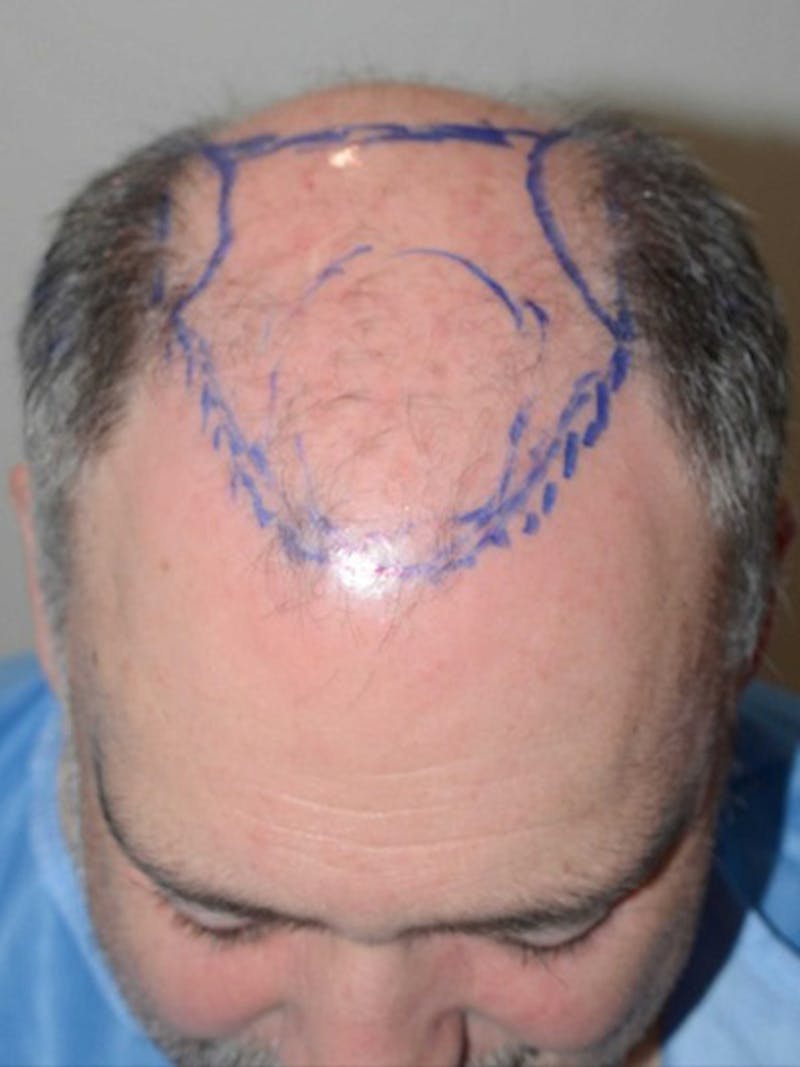 Hair Restoration for Men Before & After Gallery - Patient 380247 - Image 1
