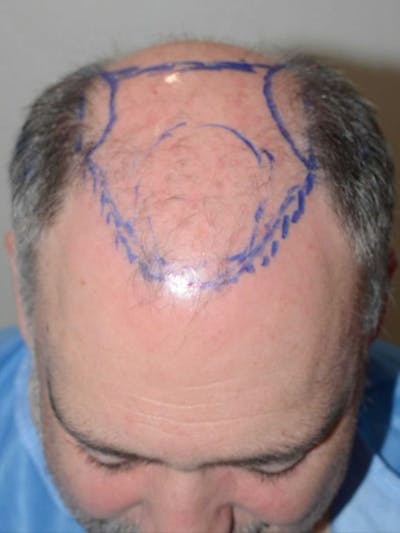 Hair Restoration for Men Before & After Gallery - Patient 254651 - Image 1