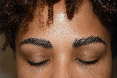 Eyebrow Transplantation Before & After Gallery - Patient 391296 - Image 2