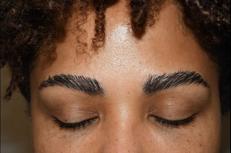 Eyebrow Transplantation Before & After Gallery - Patient 336107 - Image 2