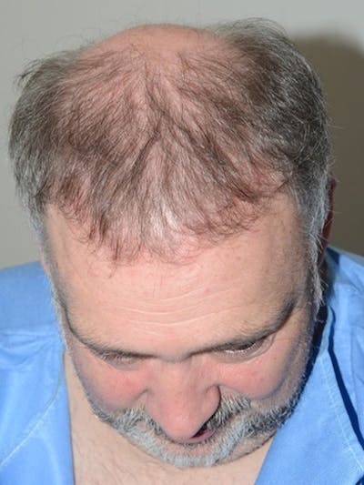 Hair Restoration for Men Before & After Gallery - Patient 254651 - Image 2