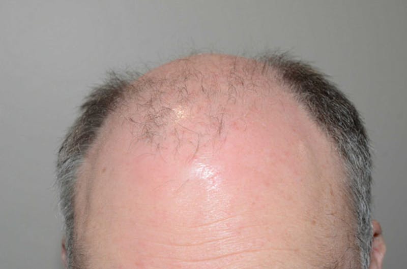Hair Restoration for Men Before & After Gallery - Patient 380247 - Image 3