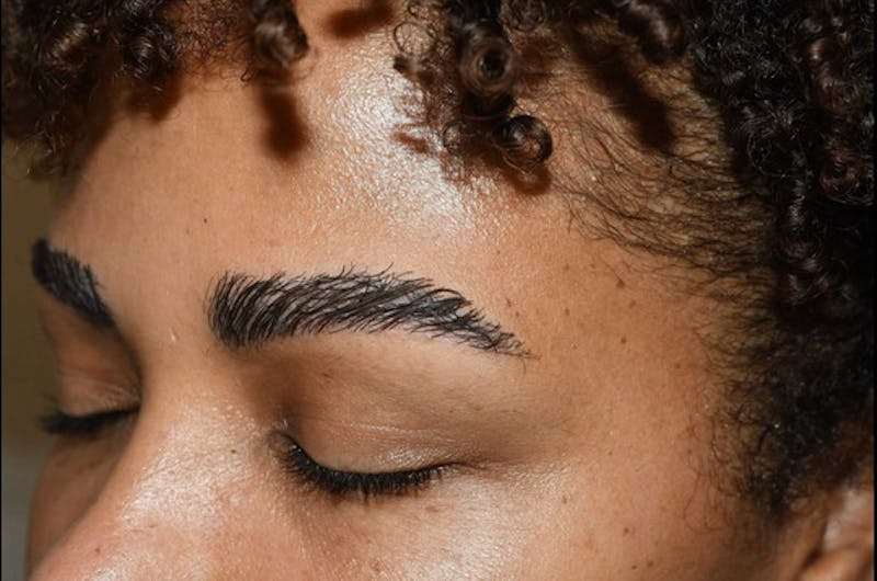 Eyebrow Transplantation Before & After Gallery - Patient 336107 - Image 4