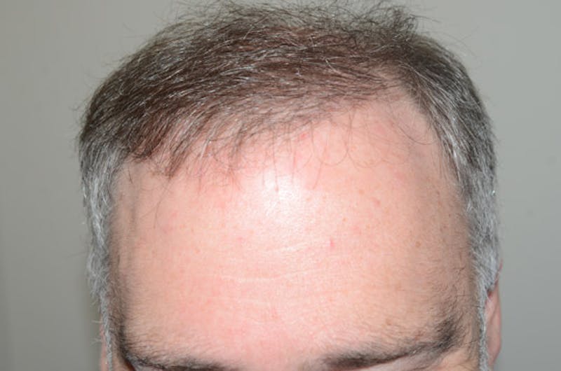 Hair Restoration for Men Before & After Gallery - Patient 380247 - Image 4