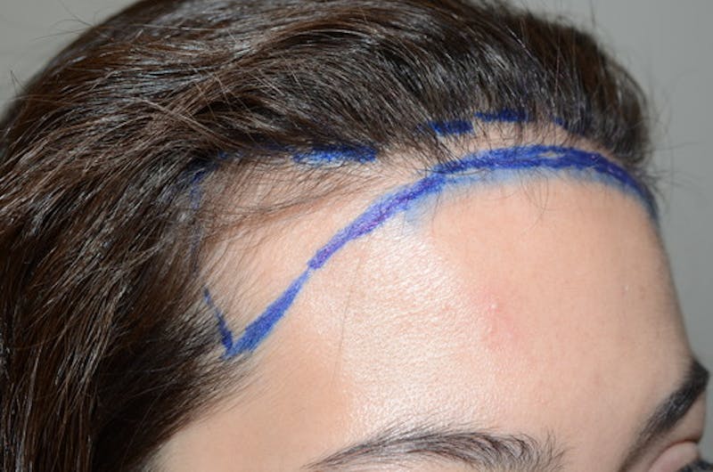 Hair Procedures for Women Before & After Gallery - Patient 114804 - Image 3