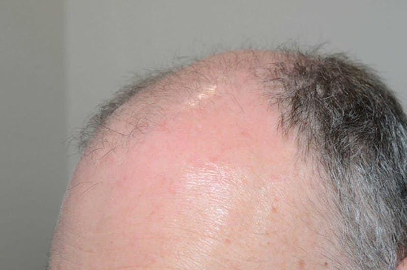Hair Restoration for Men Before & After Gallery - Patient 380247 - Image 5