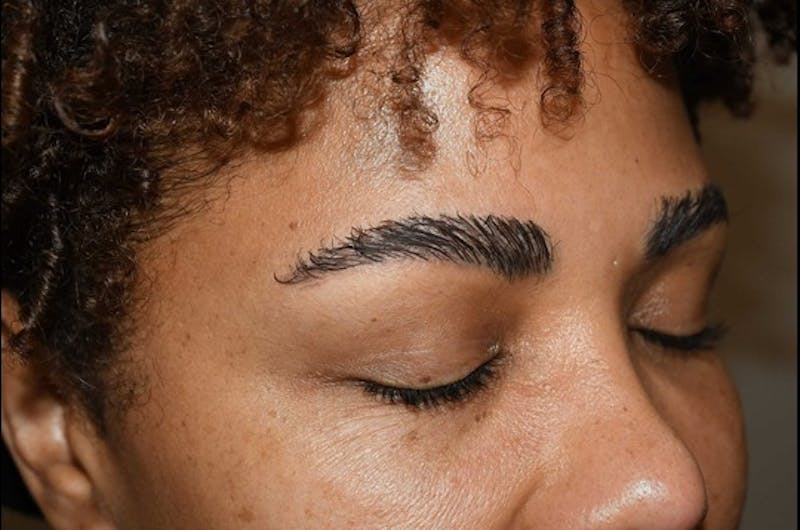 Eyebrow Transplantation Before & After Gallery - Patient 336107 - Image 6