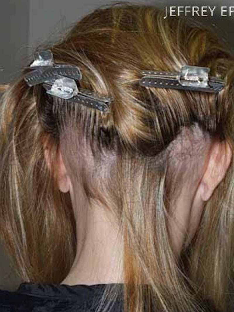 Hair Procedures for Women Before & After Gallery - Patient 127525 - Image 1