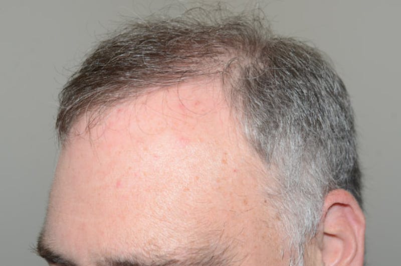 Hair Restoration for Men Before & After Gallery - Patient 380247 - Image 6