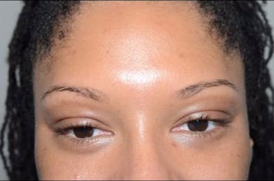 Eyebrow Transplantation Before & After Gallery - Patient 303036 - Image 1