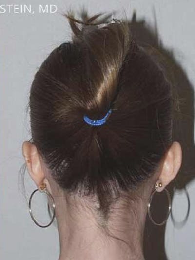 Hair Procedures for Women Before & After Gallery - Patient 151893 - Image 2