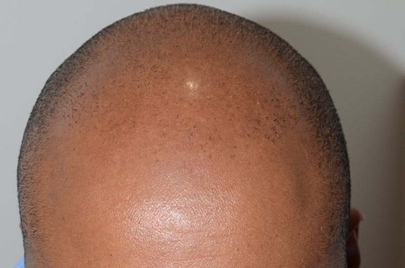 Hair Restoration for Men Before & After Gallery - Patient 768837 - Image 1