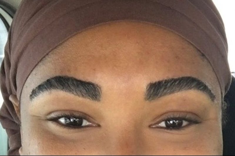 Eyebrow Transplantation Before & After Gallery - Patient 189831 - Image 2