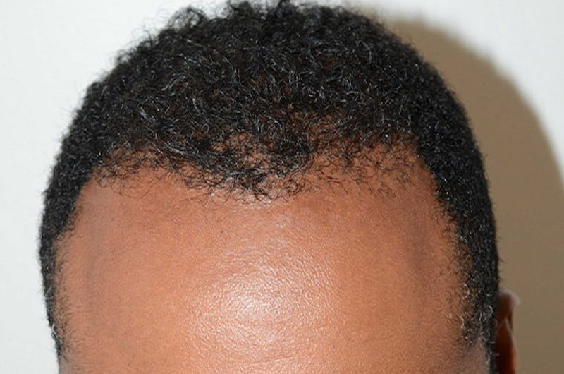 Hair Restoration for Men Before & After Gallery - Patient 768837 - Image 2