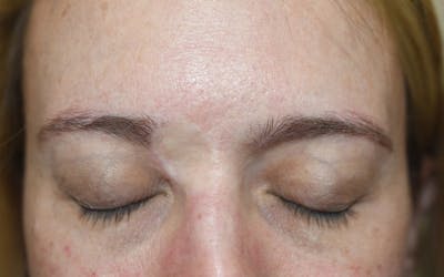 Eyebrow Transplantation Before & After Gallery - Patient 386109 - Image 1