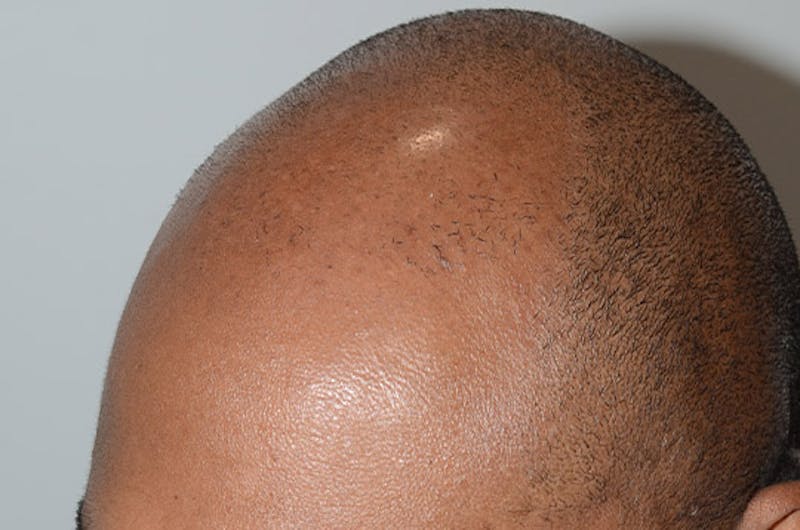 Hair Restoration for Men Before & After Gallery - Patient 768837 - Image 3