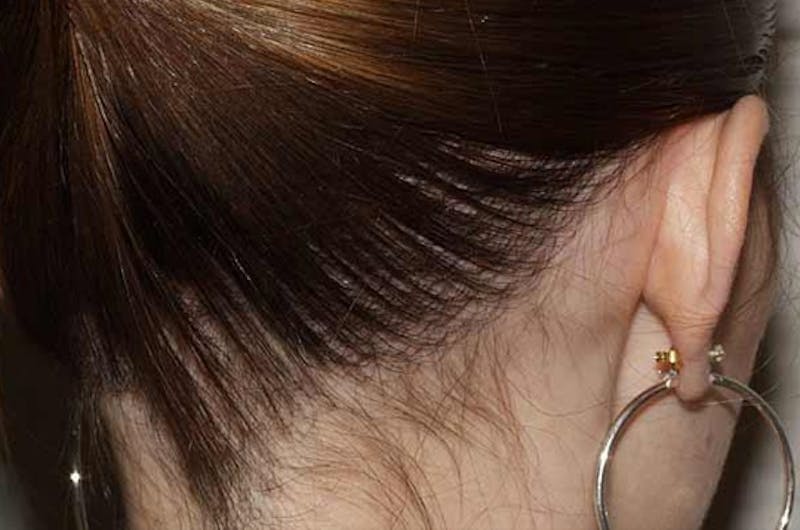 Hair Procedures for Women Before & After Gallery - Patient 127525 - Image 4