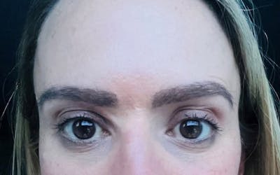 Eyebrow Transplantation Before & After Gallery - Patient 386109 - Image 2