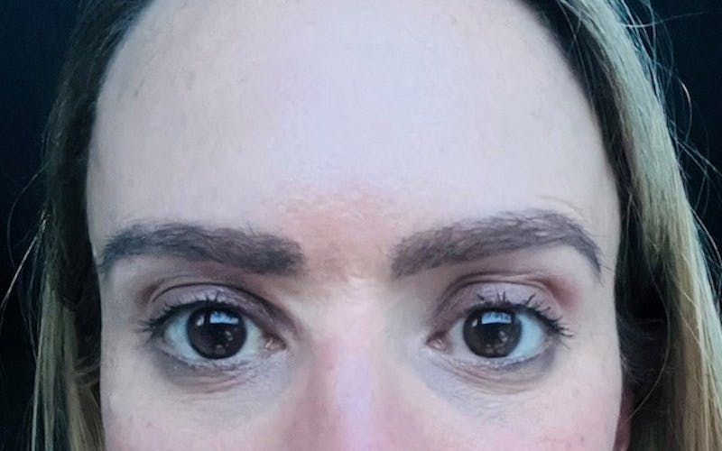 Eyebrow Transplantation Before & After Gallery - Patient 155767 - Image 2