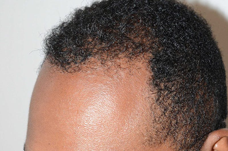 Hair Restoration for Men Before & After Gallery - Patient 768837 - Image 4