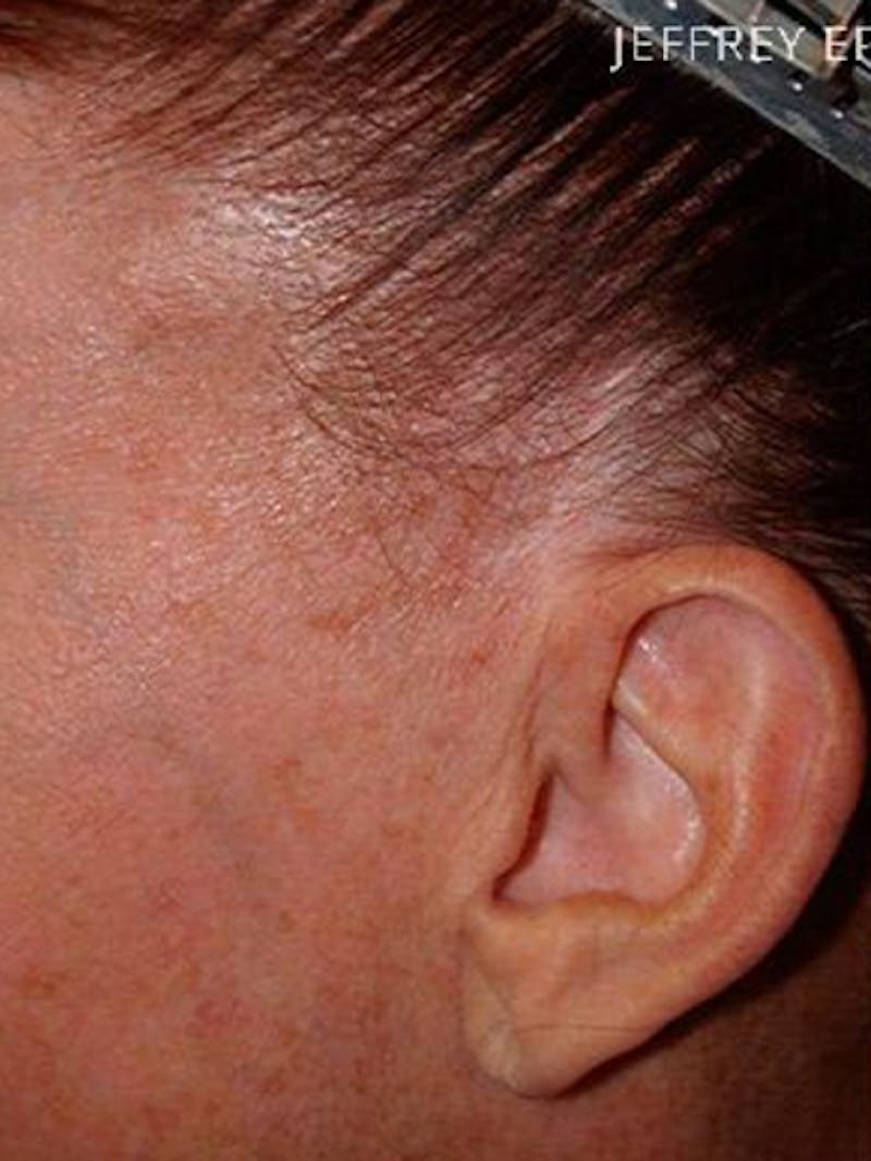 Hair Procedures for Women Before & After Gallery - Patient 104551 - Image 1