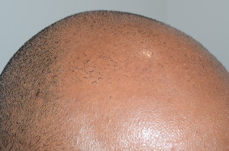 Hair Restoration for Men Before & After Gallery - Patient 768837 - Image 5