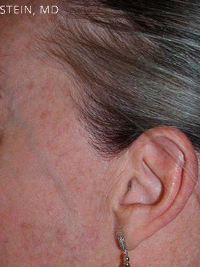 Hair Procedures for Women Before & After Gallery - Patient 129747 - Image 2