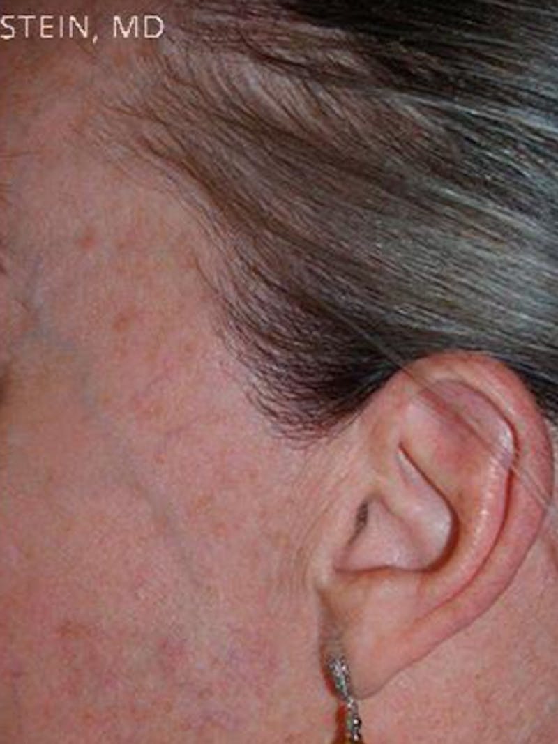 Hair Procedures for Women Before & After Gallery - Patient 104551 - Image 2