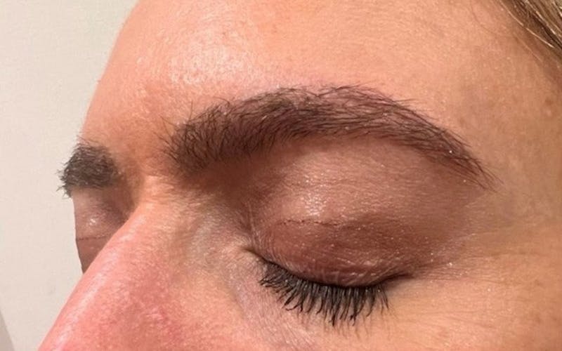 Eyebrow Transplantation Before & After Gallery - Patient 155767 - Image 4