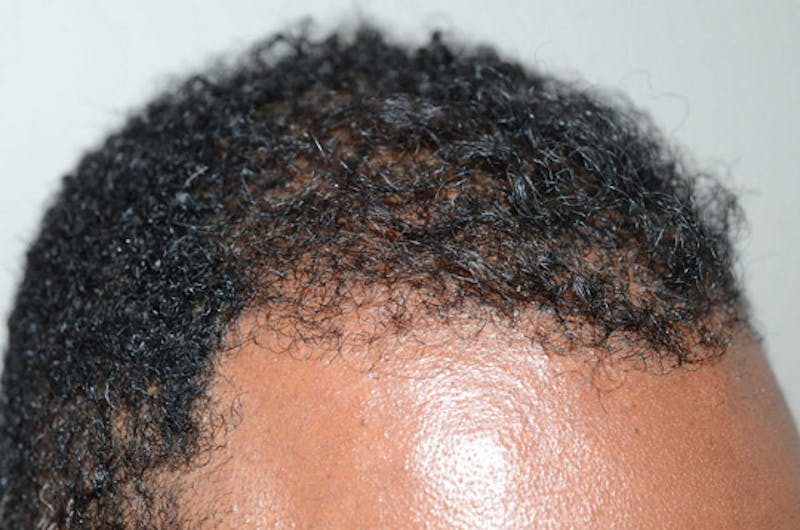 Hair Restoration for Men Before & After Gallery - Patient 768837 - Image 6