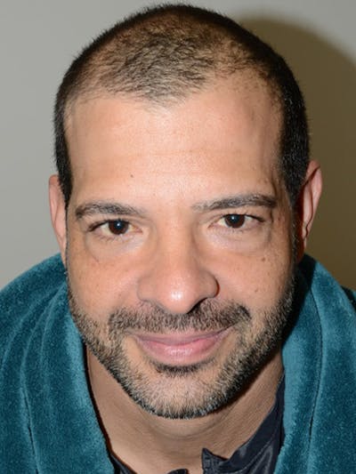 Hair Restoration for Men Before & After Gallery - Patient 391305 - Image 1