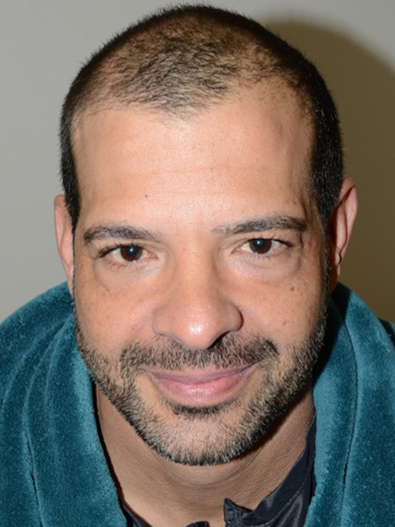 Hair Transplant Repair Before & After Gallery - Patient 144279 - Image 1