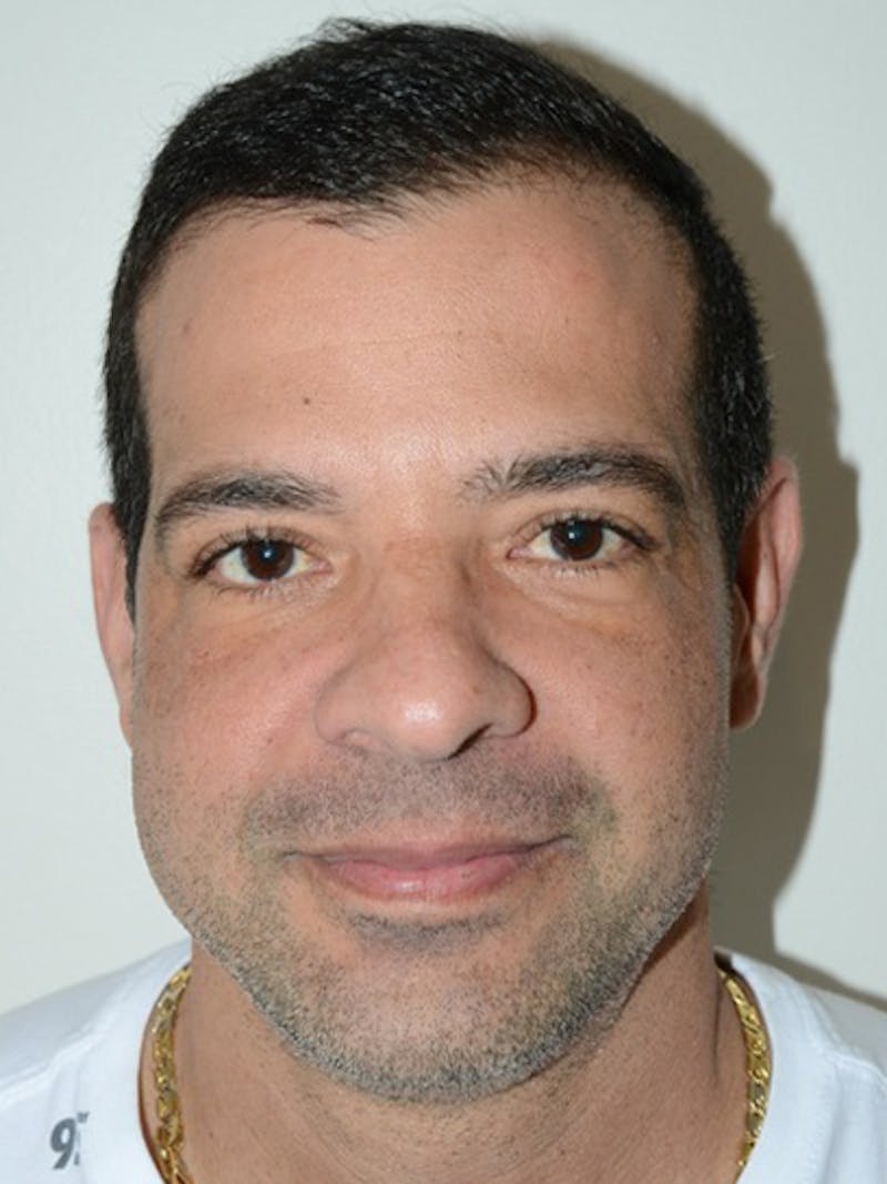 Hair Transplant Repair Before & After Gallery - Patient 144279 - Image 2