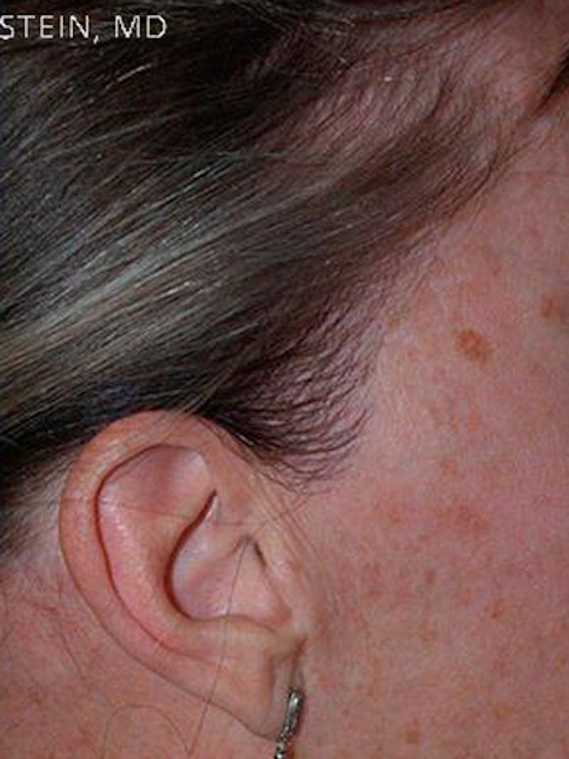 Hair Procedures for Women Before & After Gallery - Patient 104551 - Image 4