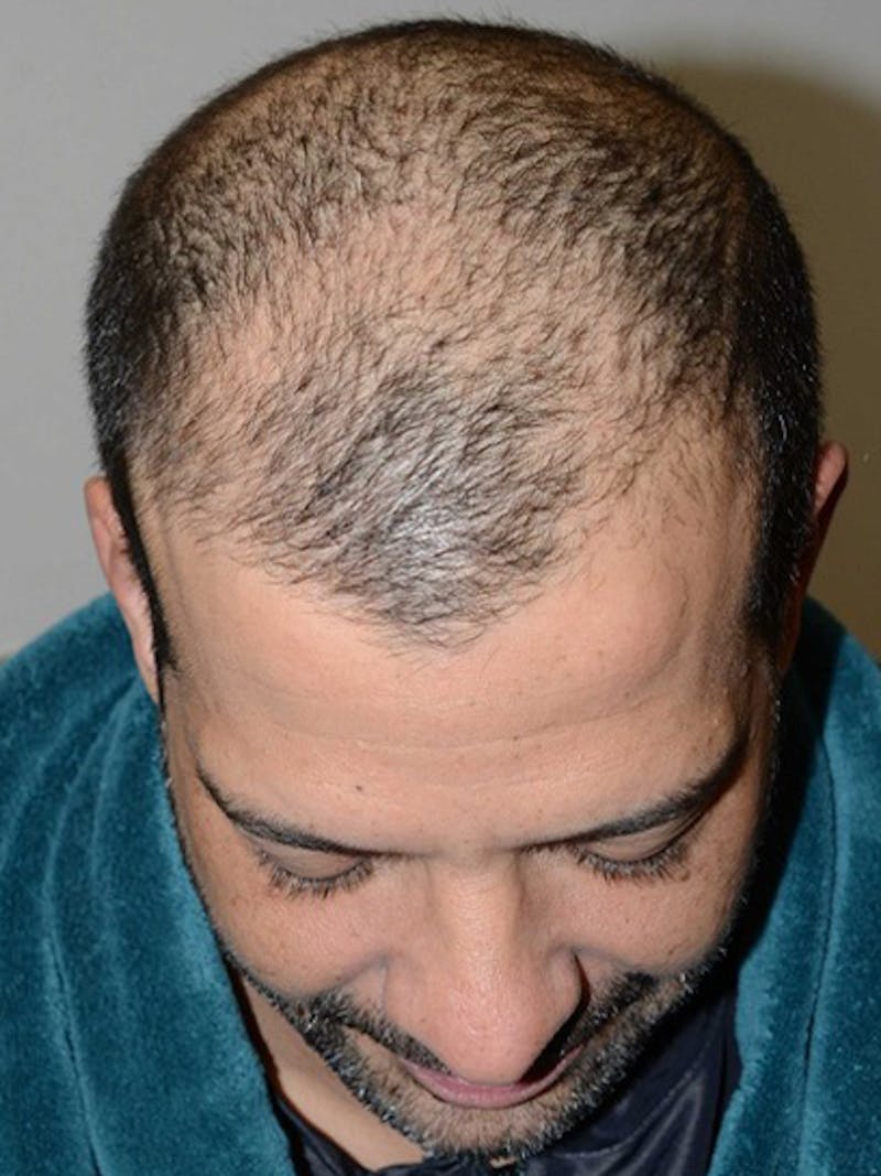 Hair Transplant Repair Before & After Gallery - Patient 144279 - Image 3