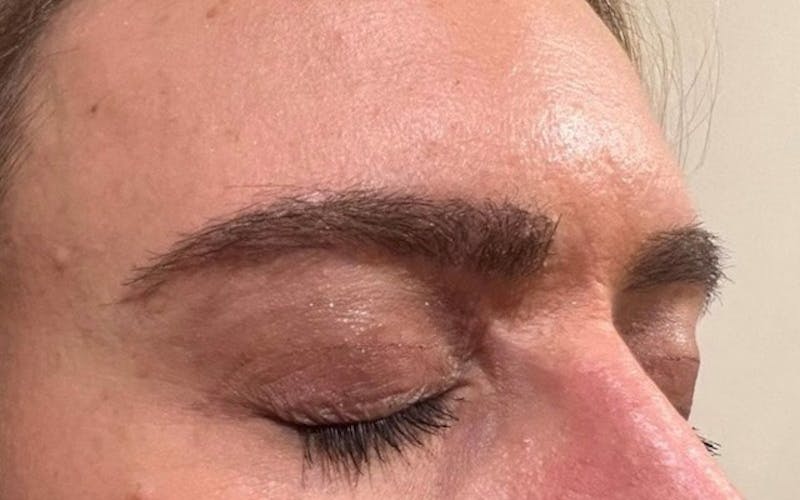 Eyebrow Transplantation Before & After Gallery - Patient 155767 - Image 6