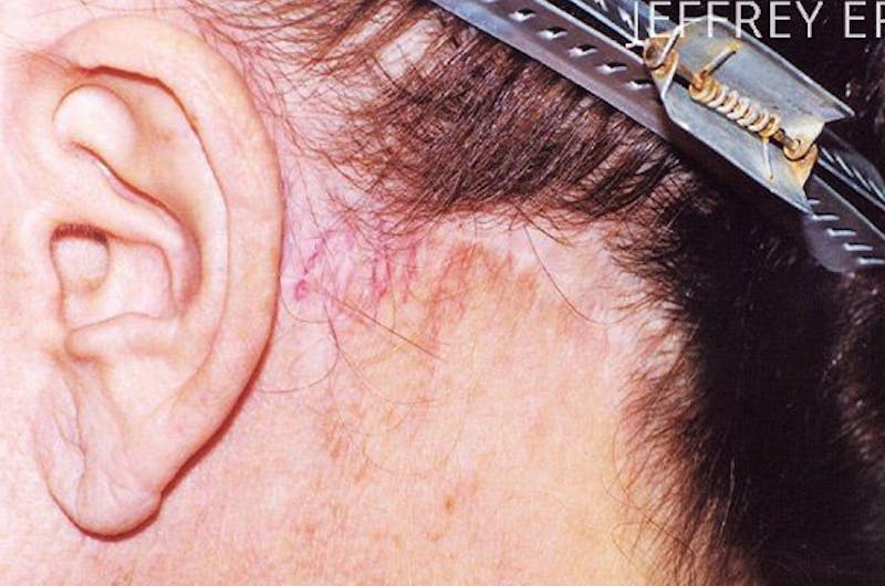 Hair Procedures for Women Before & After Gallery - Patient 125652 - Image 1