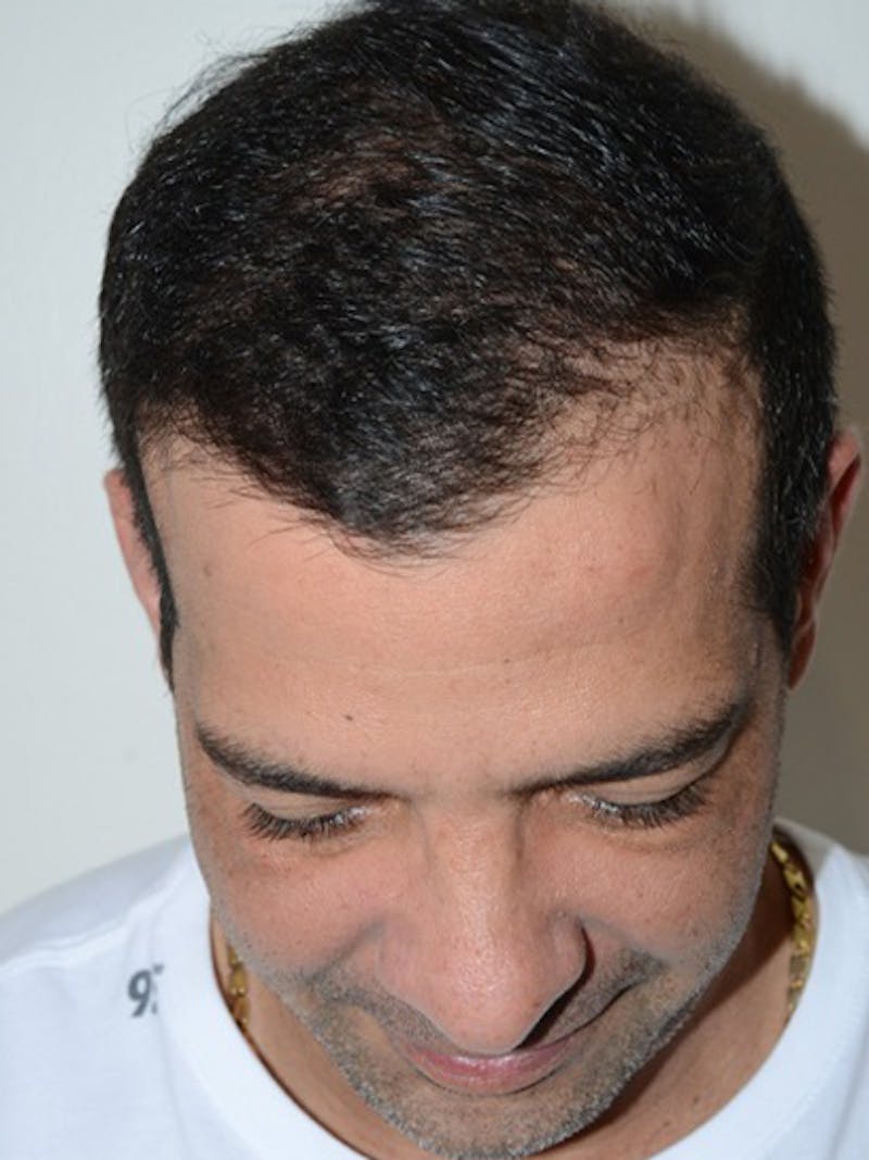 Hair Transplant Repair Before & After Gallery - Patient 144279 - Image 4