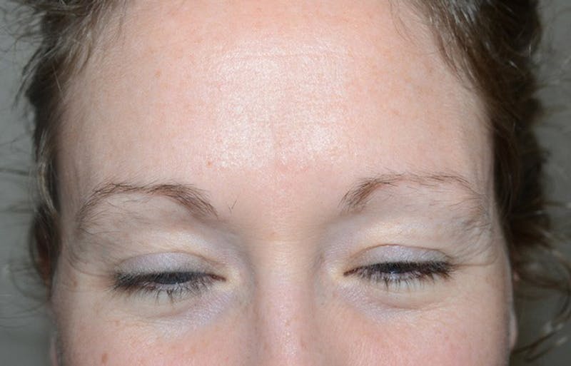 Eyebrow Transplantation Before & After Gallery - Patient 302638 - Image 1