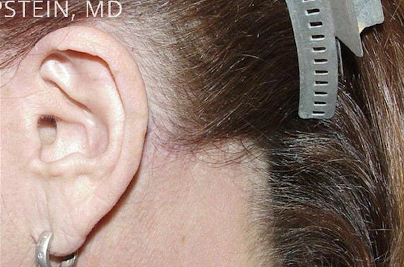 Hair Procedures for Women Before & After Gallery - Patient 125652 - Image 2
